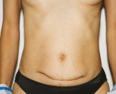 Feel Beautiful - Revision Abdominoplasty - Before Photo